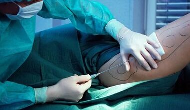 chirurgie pour perdre du poids